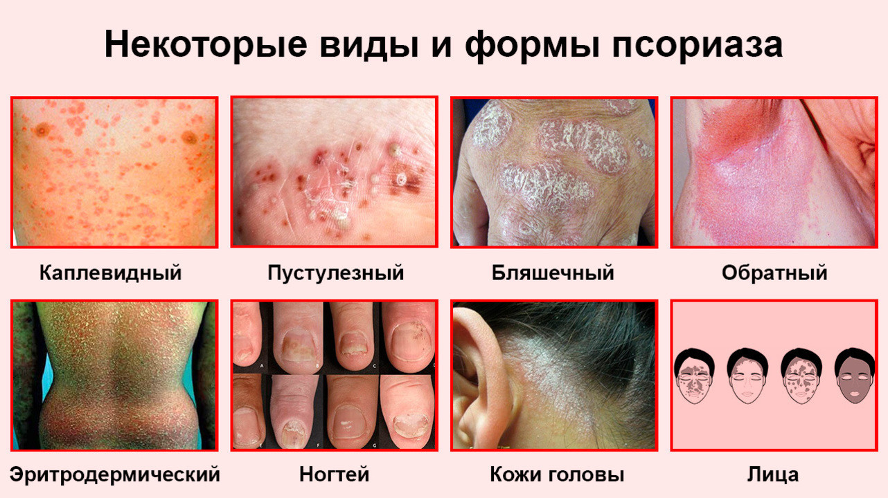 Як лікувати псоріаз: ефективні методи боротьби з хворобою Як лікувати псоріаз: ефективні методи боротьби з хворобою