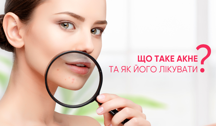 Що таке акне і як його лікувати: ефективні методи лікування