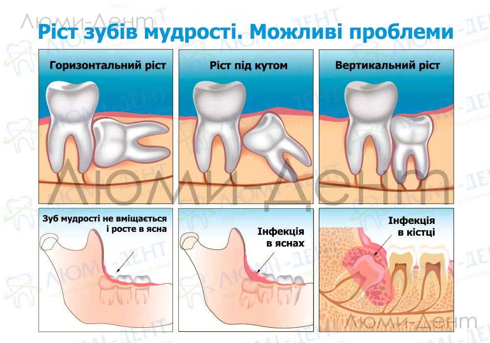 Що робити, якщо зуб мудрості болить: поради та рекомендації