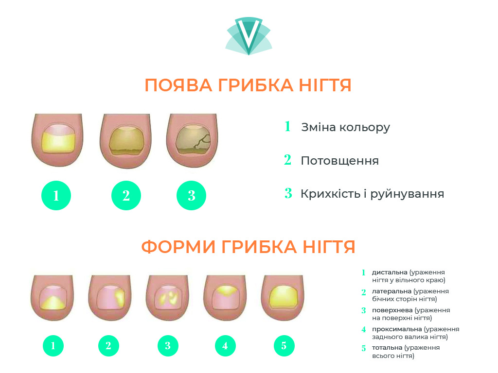 Як ефективно лікувати грибок на нігтях: поради та методи терапії