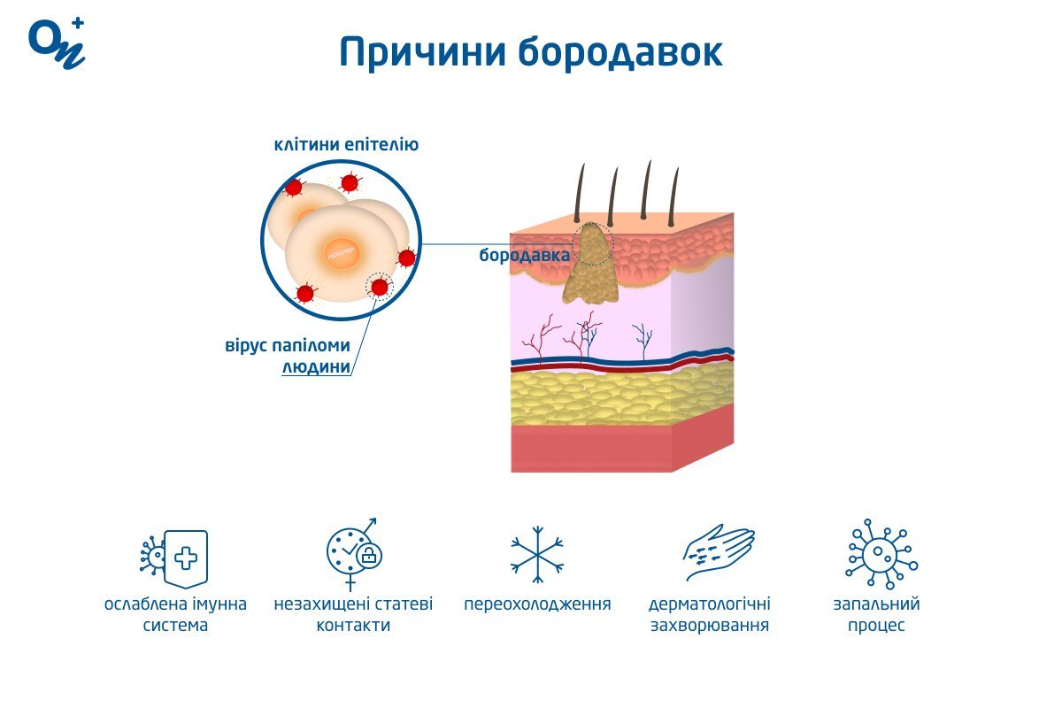 Від чого з’являються бородавки: основні причини та профілактика