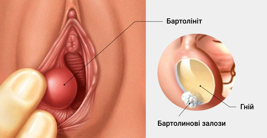 Як лікувати бартолініт в домашніх умовах: поради та методи