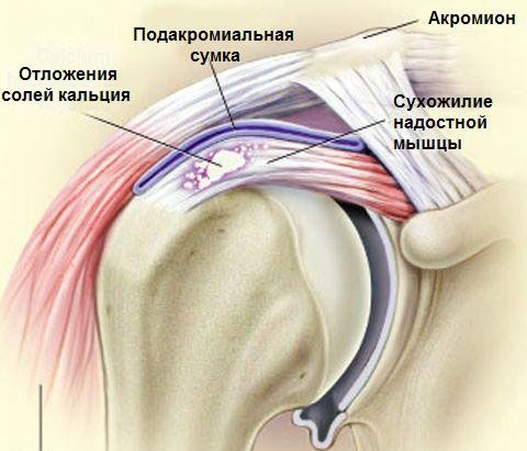 Болить рука в плечі: причини, лікування та рекомендації лікарів