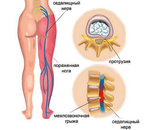 Як лікувати запалення сідничного нерва: ефективні методи та засоби